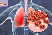 Pneumonia