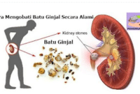 Cara Mengobati Batu Ginjal