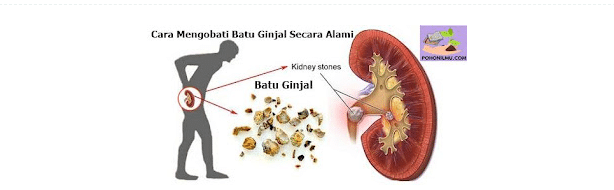 Cara Mengobati Batu Ginjal