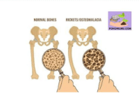 Cara Mengobati Penyakit Osteomalasia